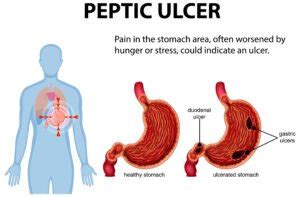 Stomach Ulcers Explained: Causes, Treatment, and Prevention Tips