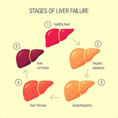 Liver Failure: Causes, Risk Factors, Symptoms, Treatment