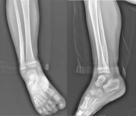 A 4-Year-Old Boy with Worsening Ankle Pain - JBJS Image Quiz