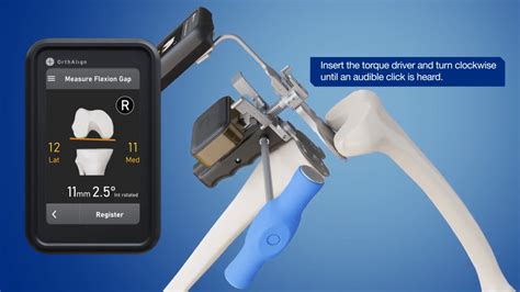 OrthAlign | Lantern Knee Overview