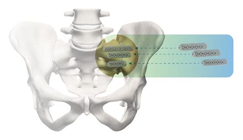How To Know If You Are A Candidate For SI Joint Fusion - Dr. Paul Norio Morton, MD, FAAOS, FAAHKS