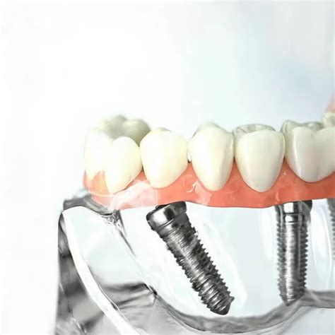 Ventajas e inconvenientes de los implantes dentales