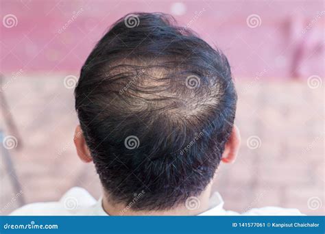 Close Up Hair Loss, Thinning Hair and Scalp Issue. Hair Loss Treatment.head with Loss Symptoms ...