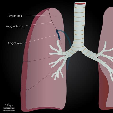 Radiopaedia - Drawing Azygos lobe - English labels | AnatomyTOOL