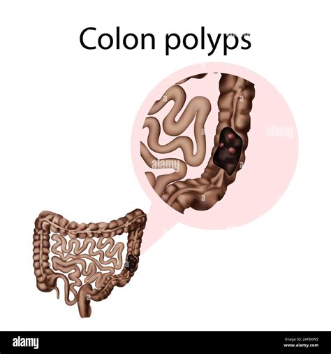 Colon Polyps Stock Photos & Colon Polyps Stock Images - Alamy