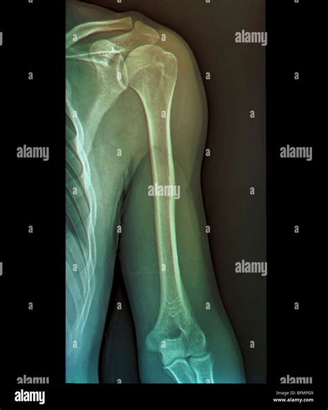 Normal shoulder joint, X-ray Stock Photo - Alamy