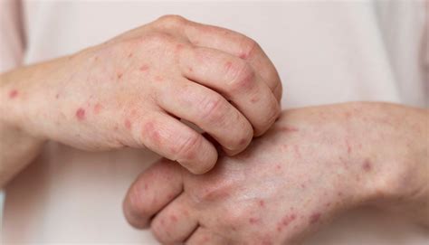 ACTINIC KERATOSIS TREATMENT