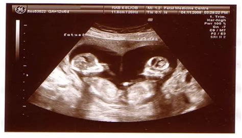 连载（九）|圆圈妈双胞胎怀孕过程第12周 – 孖仔帮