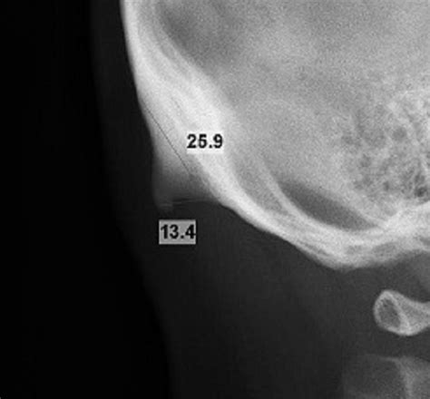 External Occipital Protuberance Bump Nerve Blocks Of The Face NYSORA