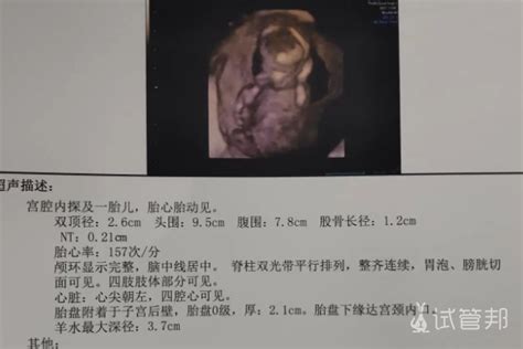 孕期NT检查：这些都是坑，孕妈们要有检前准备