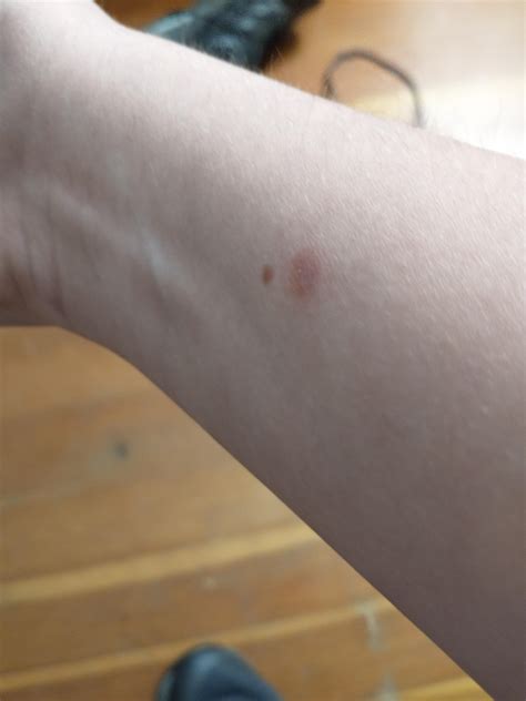 What is this red spot on my arm? Like damn I've had this for 2 years and it won't go away! Is ...