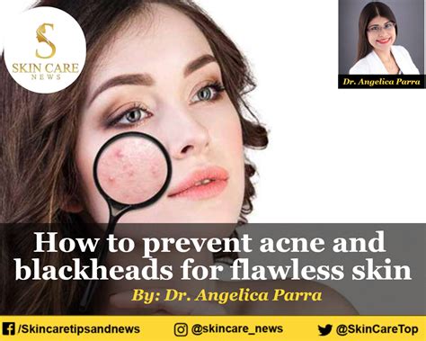 How to prevent acne and blackheads for flawless skin - how to prevent blackheads