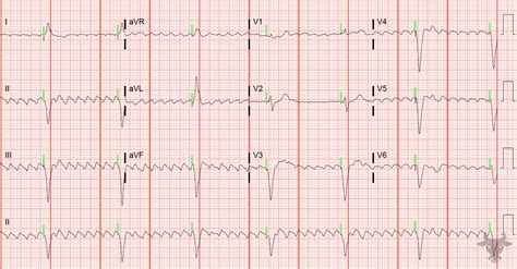 Atrial Flutter | ECG Stampede