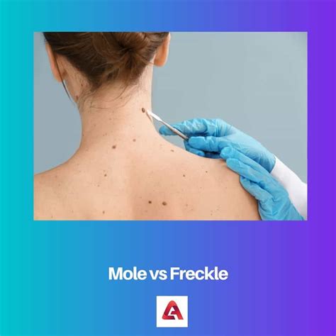 Mole vs Freckle: Difference and Comparison