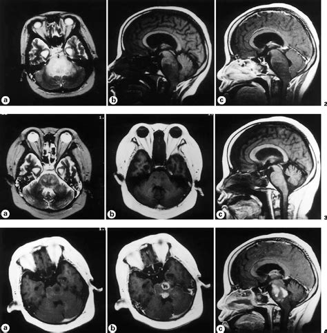Figure 1 from Diffuse Brainstem Glioma in a Patient with Laurence-Moon-(Bardet-)Biedl Syndrome ...