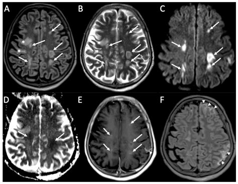 Neuroimaging of the Most Common Meningitis and Encephalitis of Adults ...