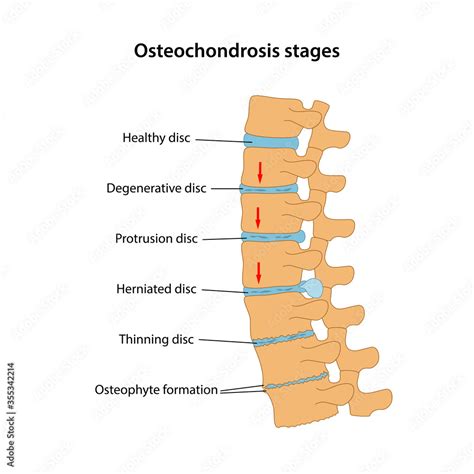 Stages of spinal osteochondrosis with main description: healthy disc ...