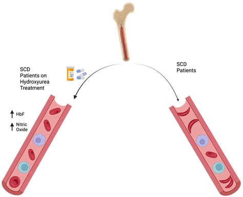 Hope on the Horizon: New and Future Therapies for Sickle Cell Disease