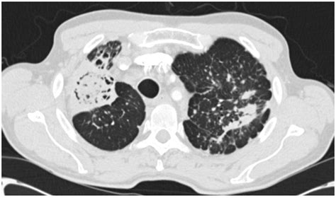 Chronic Pulmonary Aspergillosis—Where Are We? and Where Are We Going?