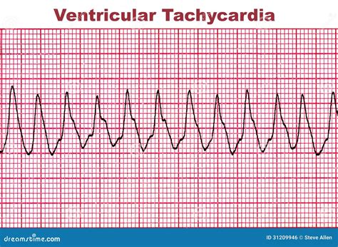 EKG cardio - Mind Map