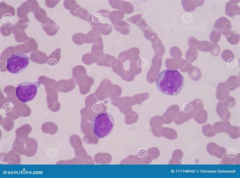 Blast Cells of White Blood Cell. Stock Photo - Image of background ...