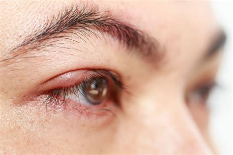 Eyelid Bumps 101: How to Identify Styes, Milia & Pimples | Allure