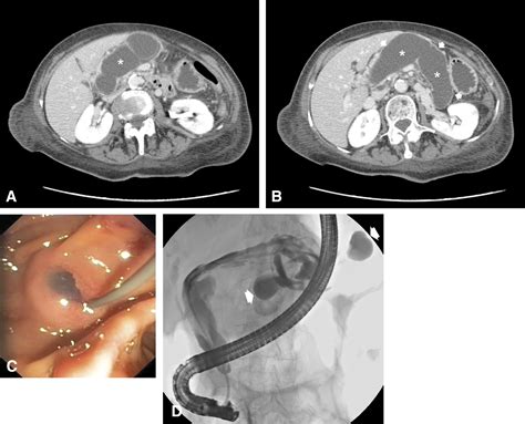 “Doctor, I have a long, sausage-shaped lump in my abdomen” - Gastrointestinal Endoscopy