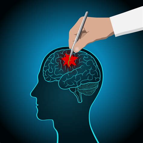 Here's why the 90-day 'golden period' in post-stroke rehabilitation is