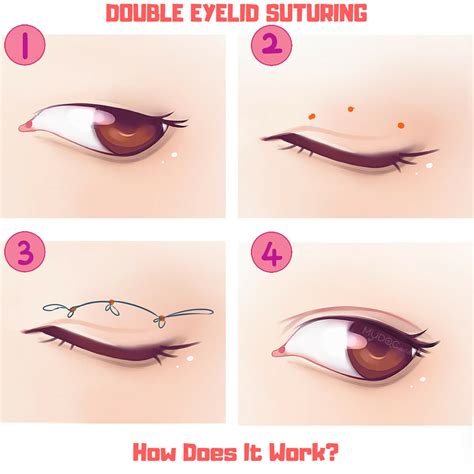 How to Get Double Eyelids Without Surgery? Answered by Beverly Wilshire ...
