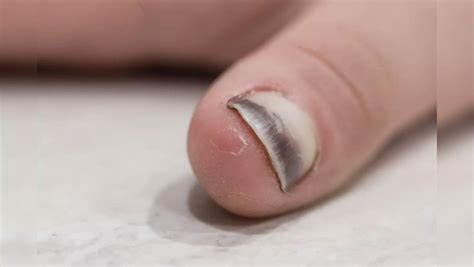 Cancer: Symptoms of deadly tumour that may crop up on your nails ...