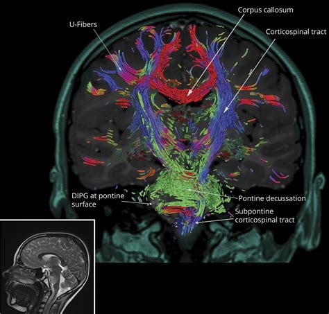 Teaching NeuroImages: Diffuse intrinsic pontine glioma in white matter | Neurology