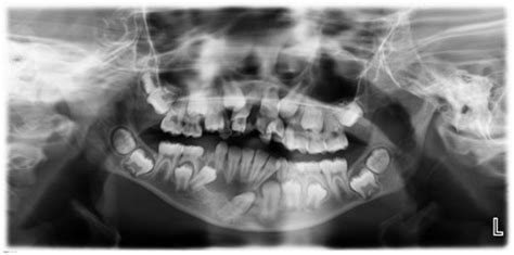Abnormal Panoramic Dental X Ray