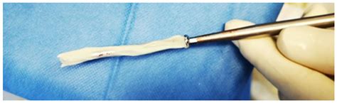 Bone Lengthening with a Motorized Intramedullary Nail in 34 Patients ...