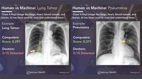 Pneumonia Chest X Ray Compared To Normal