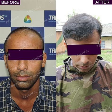 Trichos | Best Hair Treatment in Hyderabad | Dr John Watts