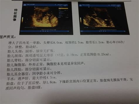 NT检查费用多少钱？_妇幼保健站的大夫建议12周时做NT检查_宝宝树