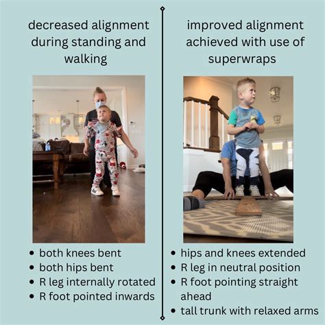 Image result for Normal Leg Alignment