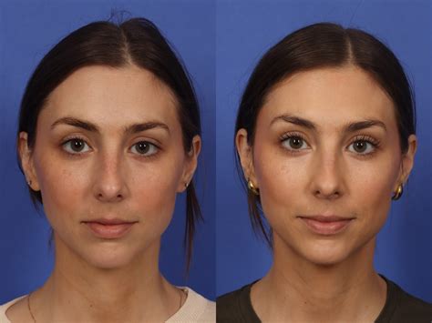 What Botox Looks Like After Years of Use, According to Derms