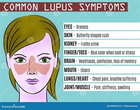 Common Lupus Symptoms. Illustration of Young Woman with Lupus Syndrome Stock Illustration ...