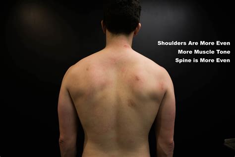 Winged Scapula and Shoulder Pain [Case Study] — ONI | Wellington Personal Training Studio