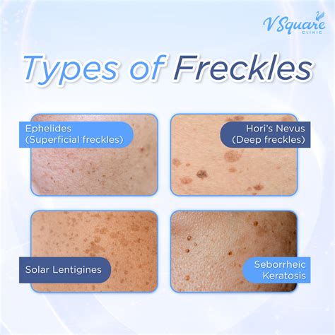 Freckles – Causes and Treatments for Clear, Smooth Skin