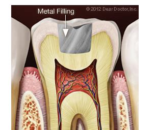Get Tooth Restoration (Fillings) for a Healthy Smile