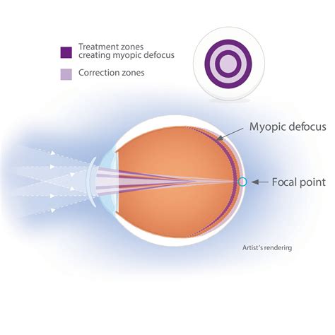 Misight Contact Lenses Cost Uk at Holly Standley blog