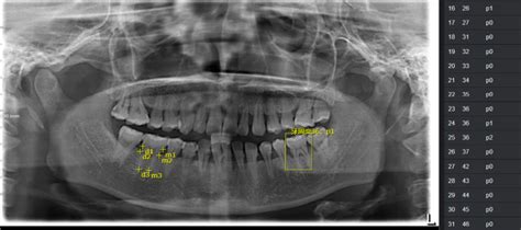 New AI model may accurately diagnose periodontal bone loss and ...