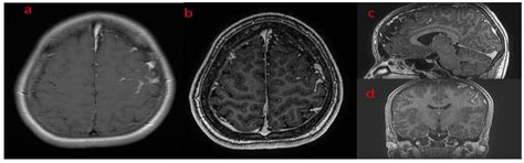 Encephalocraniocutaneous Lipomatosis, a Radiological Challenge: Two ...