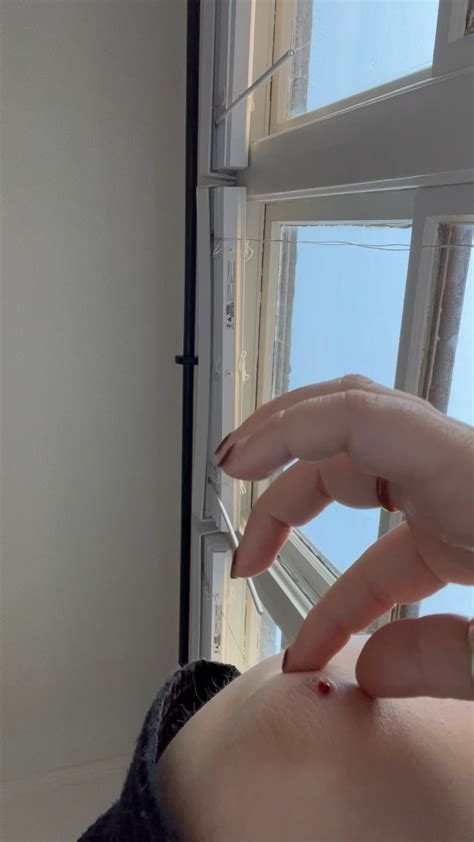 Image result for Elbow Cysts Explode