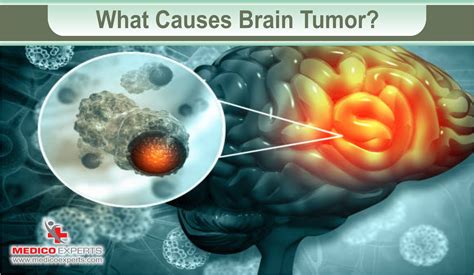Brain Tumor Symptoms: Learn to save lives