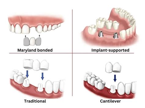 Cantilever Dental Bridge Facts