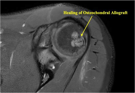 All-Arthroscopic Treatment of Off-Track Hill–Sachs Lesions Using Fresh Osteochondral Allograft ...