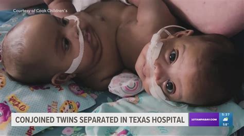 Siamese Twins Separated Successfully